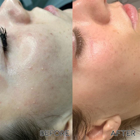 Oveallgo™ Milia Clearing Essence - Image 5