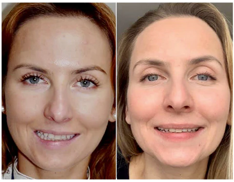 GFOUK™ EMSculpt V-Face Beauty Sleeping Device - Image 8