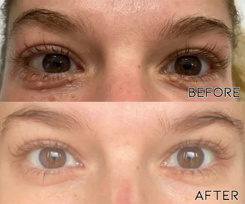 Oveallgo™ Milia Clearing Essence - Image 4