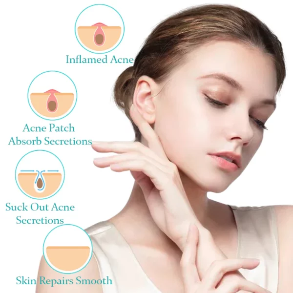 ACRēN™ Hydrocolloid Face Patches - Image 5