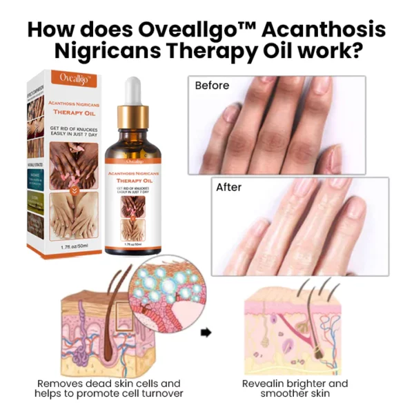 Oveallgo™ Acanthosis Nigricans Therapy Oil - Image 5