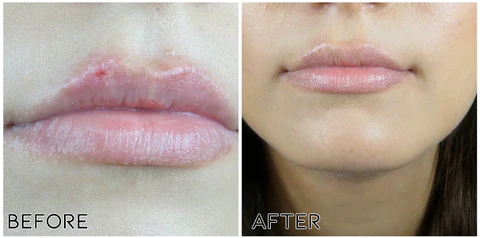 LipClear Cold Sore Honey Patch - Image 8