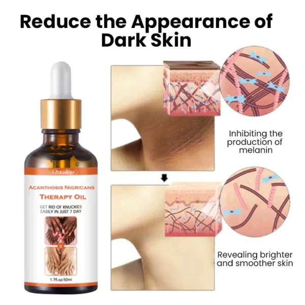 Oveallgo™ Acanthosis Nigricans Therapy Oil - Image 4