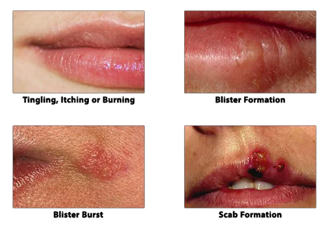 LipClear Cold Sore Honey Patch - Image 7