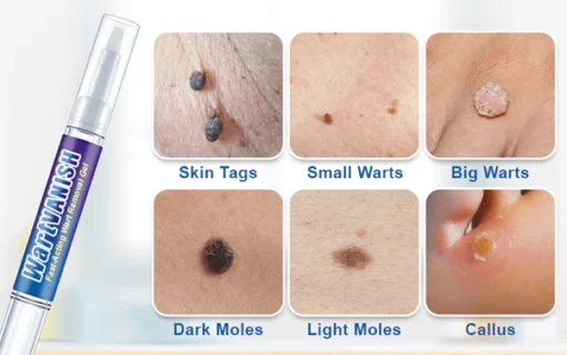 WartVanish™ Fast-Acting Wart Removal Gel - Image 6