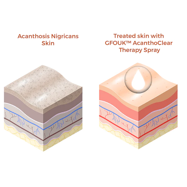 GFOUK™ AcanthoClear Therapie-Spray - Image 4