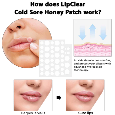 LipClear Cold Sore Honey Patch - Image 6