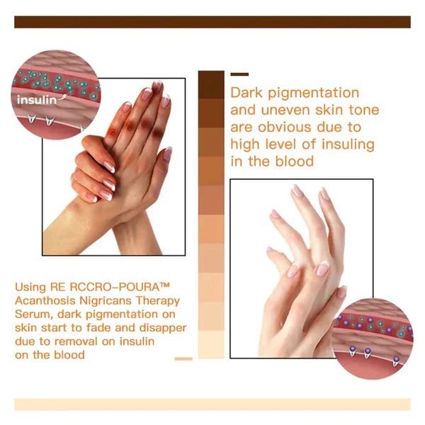 RE RCCRO-POURA™ Acanthosis Nigricans Therapy Serum - Image 4