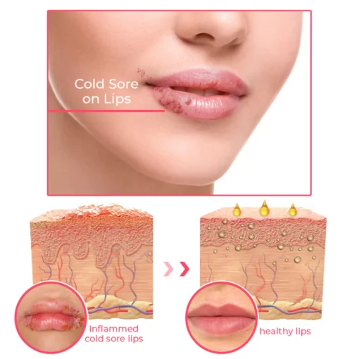 GFOUK™ Cold Sores Therapy Oil - Image 6