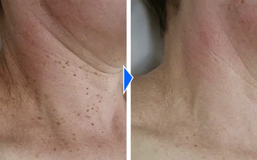 WartVanish™ Fast-Acting Wart Removal Gel - Image 5