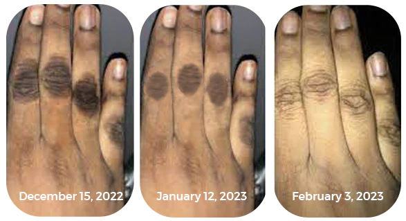 GFOUK™ AcanthoClear Therapy Spray - Image 7