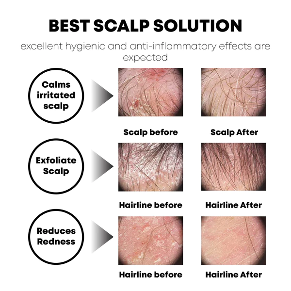 ATTDX SeborrhoeicDermatitis ScalpCare TreatmentCream - Image 5