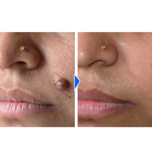 WartVanish™ Fast-Acting Wart Removal Gel - Image 4