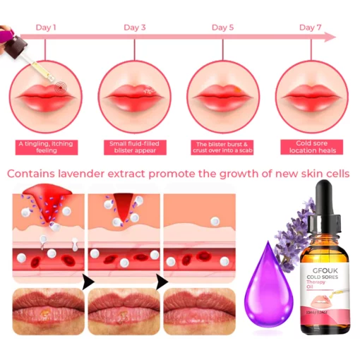 GFOUK™ Cold Sores Therapy Oil - Image 5