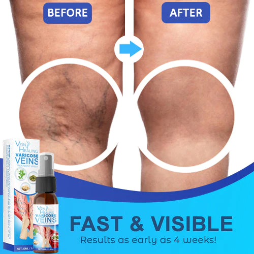 Veinhealing Varicose Veins Treatment Spray - Image 7