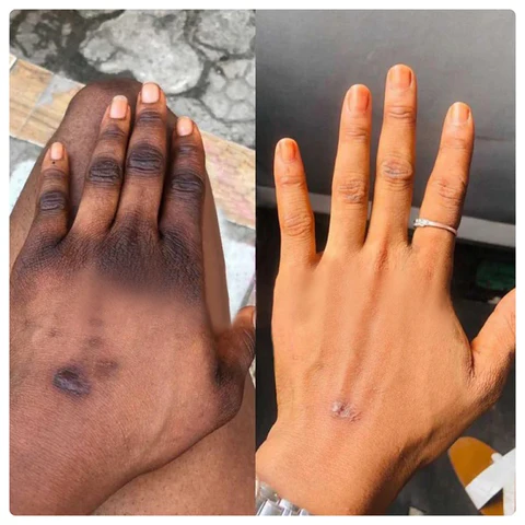 Fivfivgo™ Acanthosis Nigricans Therapy Cream - Image 4