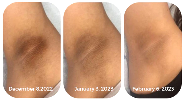 GFOUK™ AcanthoClear Therapy Spray - Image 6