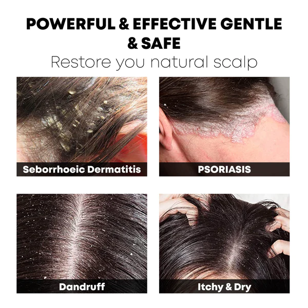 ATTDX SeborrhoeicDermatitis ScalpCare TreatmentCream - Image 4