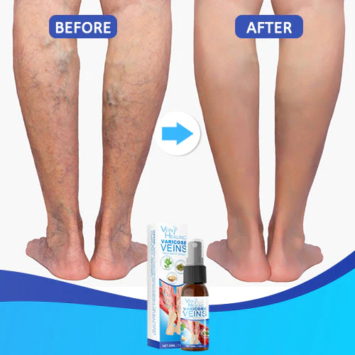 Veinhealing Varicose Veins Treatment Spray - Image 6