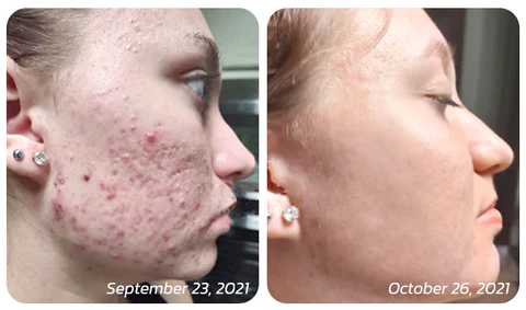 HyaluFix ™ Pockmark Heal Microdart Roller - Image 3