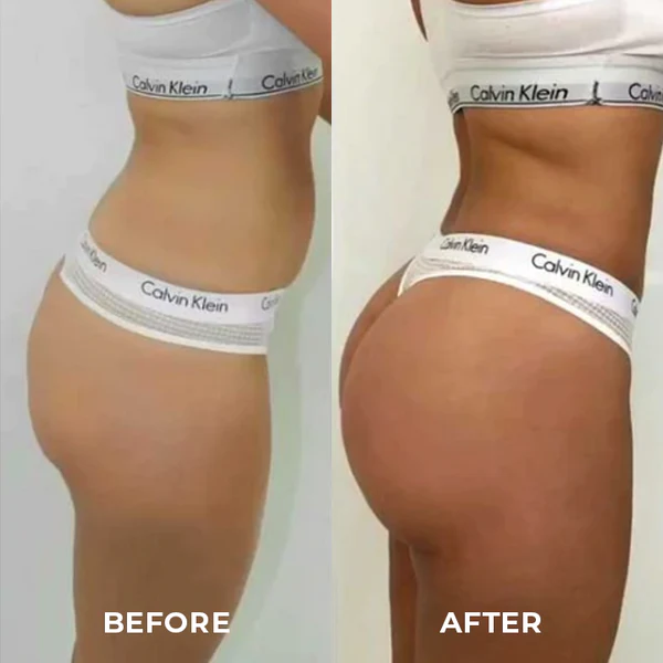 ShapeZ™ Buttock Lifting Instrument - Image 4