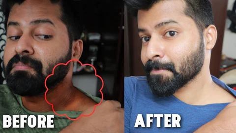 Fivfivgo™ Acanthosis Nigricans Therapy Cream - Image 3