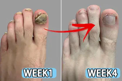 FootFree™ Antifungal – Professional Strength - Image 3