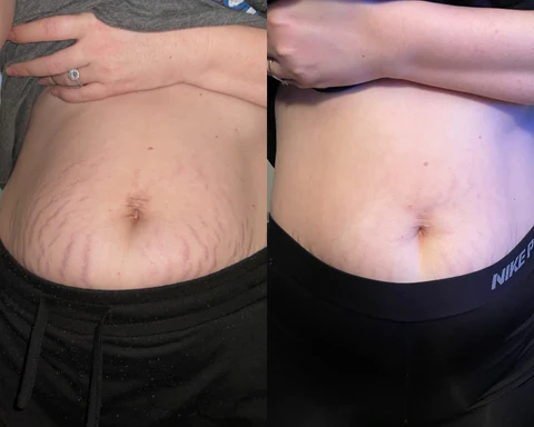 AEXZR™ Stretchmark Repair Cream - Image 3