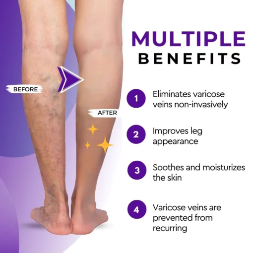 VeinGone™ Varicose Fading Cream - Image 7