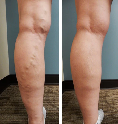 VeinGone™ Varicose Fading Cream - Image 5