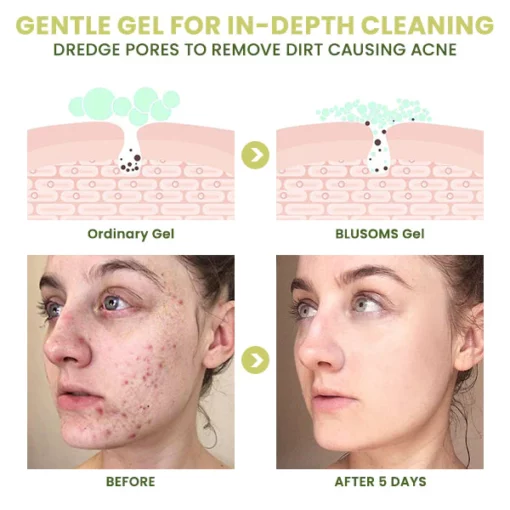 Blusoms™ ClearAcne Defense Gel - Image 5
