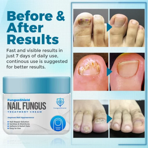 Biancat™ FungiClear Nail Treatment Cream - Image 6