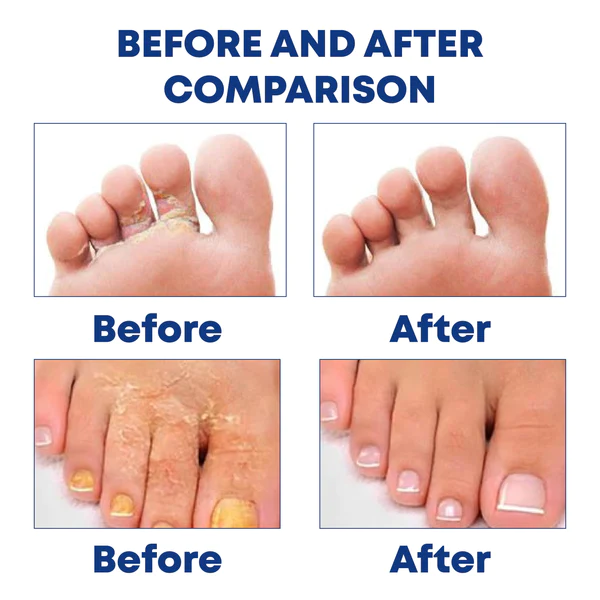 ATTDX FootCare AntiFungal HerbalBath Treatment - Image 6