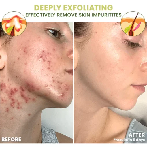 Blusoms™ ClearAcne Defense Gel - Image 3