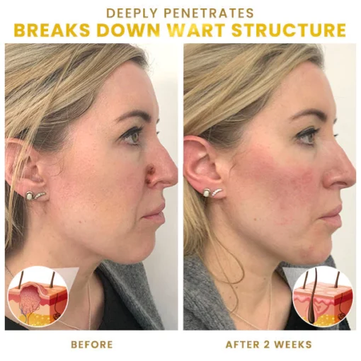 Blusoms™ Lucid WartPro Plus+ Ampoules Essence - Image 6