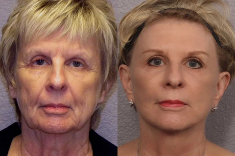 Oveallgo™ MMP Reverse Anti-Wrinkle Antioxidant Serum - Image 3