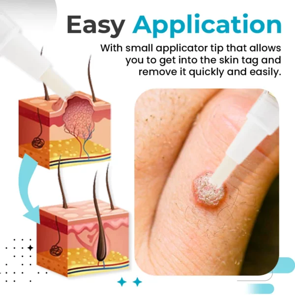 DermiClearPlus™ Skin Tag & Wart Remover Pen - Image 6