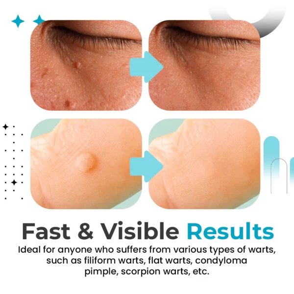 DermiClearPlus™ Skin Tag & Wart Remover Pen - Image 5