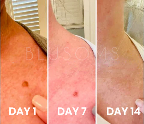 Blusoms™ Lucid WartPro Plus+ Ampoules Essence - Image 3