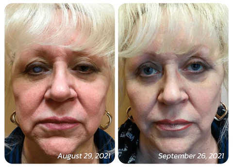 GFOUK™ Precision OphthlaMed Vision Enhance Patch - Image 5