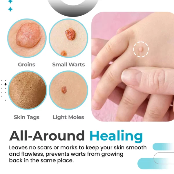 DermiClearPlus™ Skin Tag & Wart Remover Pen - Image 4