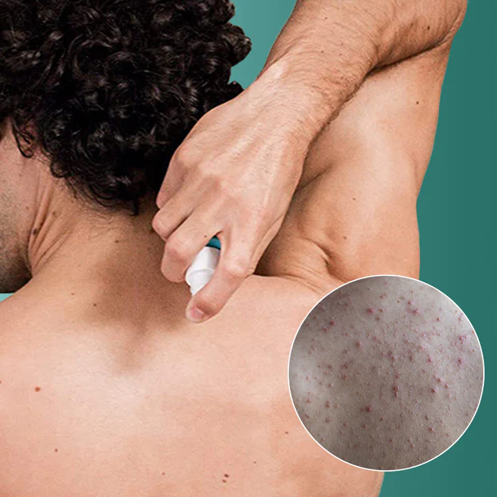 PureBAC™ Back Acne Herbal Spray - Image 6