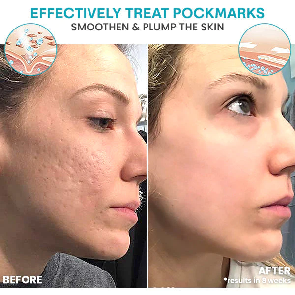 Liascy™ Baume HyaloVitality Microdarts Roller - Image 5