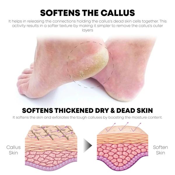 ATTDX FootCalluses CornRemoval Treatment Spray - Image 3