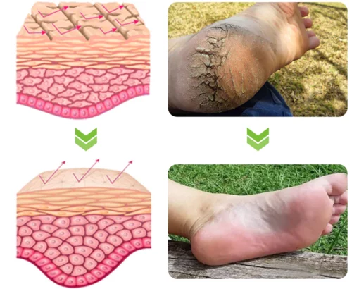 GFOUK™ IHerbal Foot Callus And Corns Removal Soak - Image 9