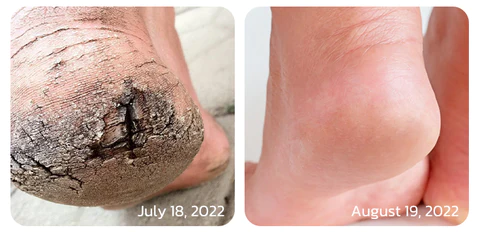 GFOUK™ IHerbal Foot Callus And Corns Removal Soak - Image 5