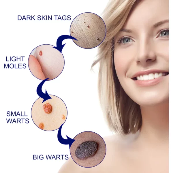 OUHOE™ Tags & Moles Remover - Image 5