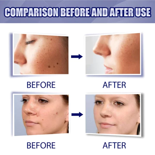 OUHOE™ Tags & Moles Remover - Image 4