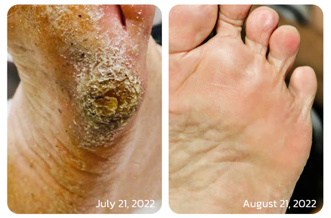 GFOUK™ IHerbal Foot Callus And Corns Removal Soak - Image 4