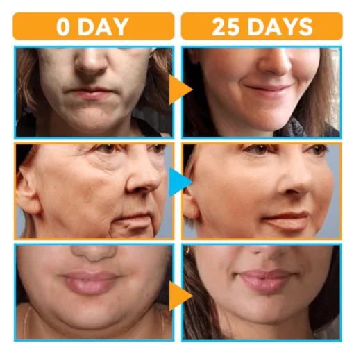 GFOUK™ HIFU Face Lifting Instrument - Image 7